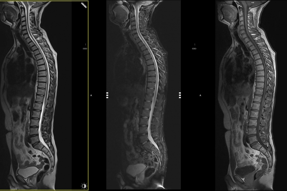 Whole-body magnetic resonance imaging (MRI) in the onco-rads standard